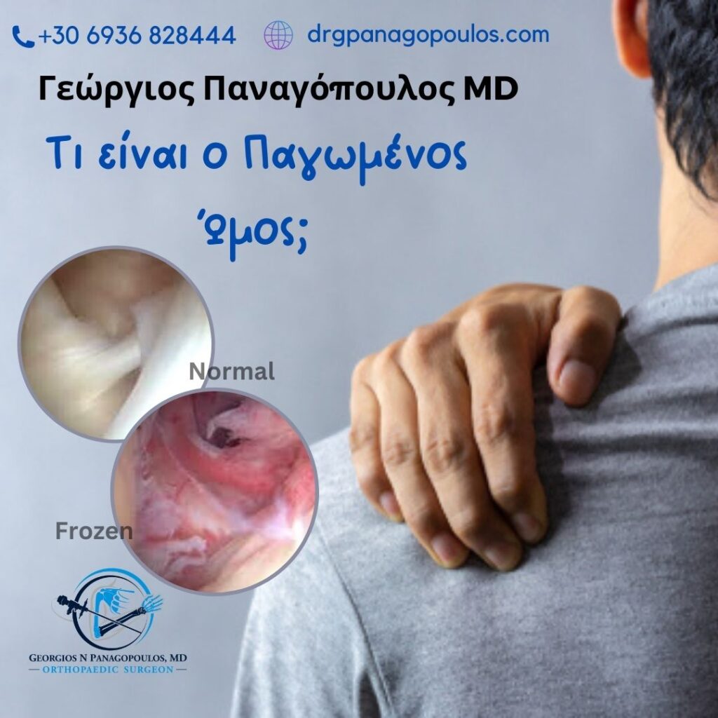 Παγωμένος ώμος - τι είναι