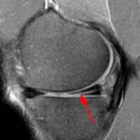 Ρήξη μηνίσκου MRI sagittal