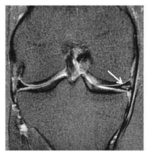 Ρήξη μηνίσκου MRI coronal