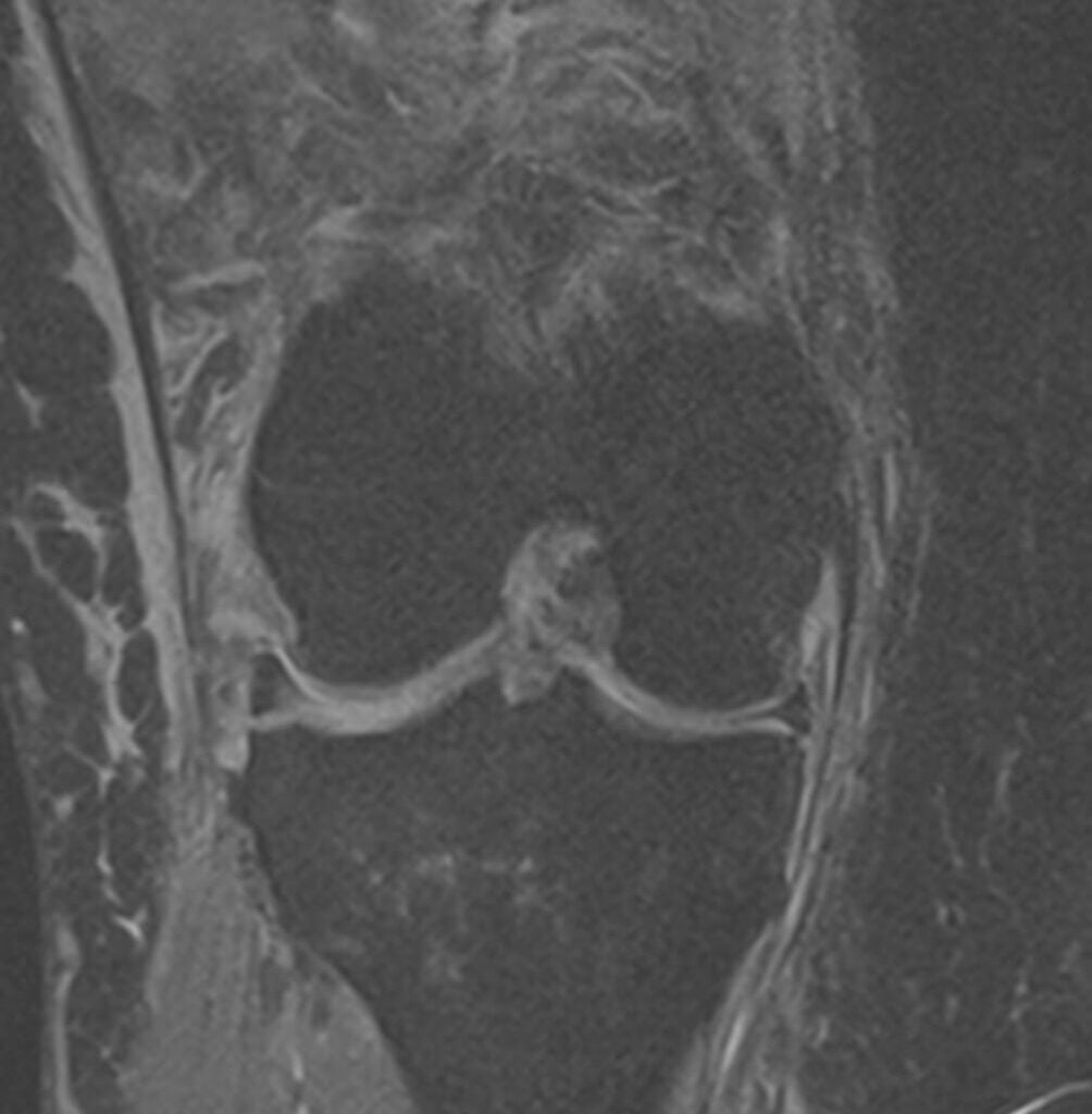Ρήξη προσθίου χιαστού MRI coronal