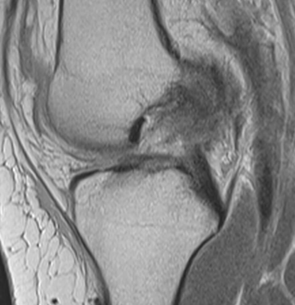 Ρήξη προσθίου χιαστού MRI sagittal