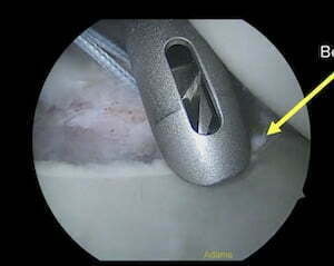 Τοποθέτηση αγκυρών για αστάθεια ώμου