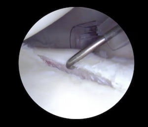 Βλάβη Bankart κατά την αρθροσκόπηση