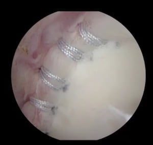 Αρθροσκοπική αποκατάσταση ώμου μετά από εξάρθρημα - αστάθεια