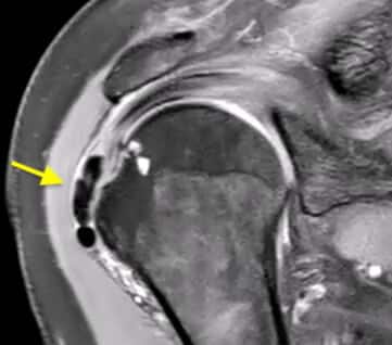 Ασβεστοποιός τενοντίτιδα MRI 2