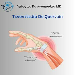 Τενοντίτιδα de Quervain 1