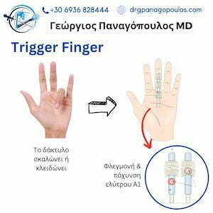 Εκτινασσόμενος δάκτυλος ή trigger finger