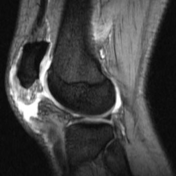 Patellar tendon tear MRI sagittal view