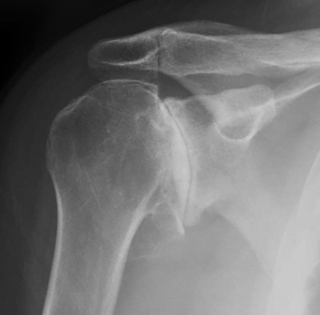 Shoulder arthritis X-ray