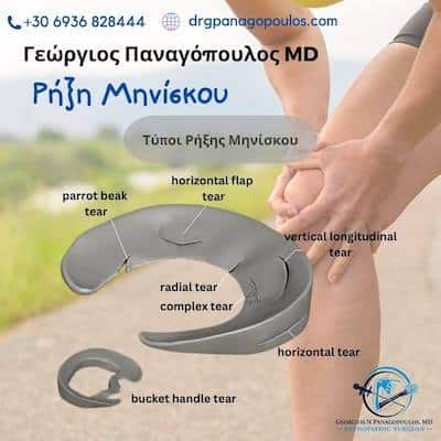 Ρήξη μηνίσκου