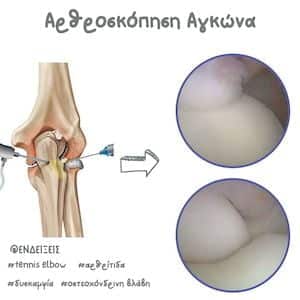Αρθροσκόπηση αγκώνα