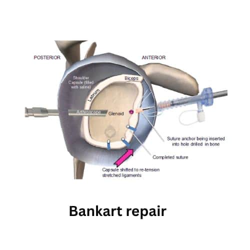 Bankart repair 1