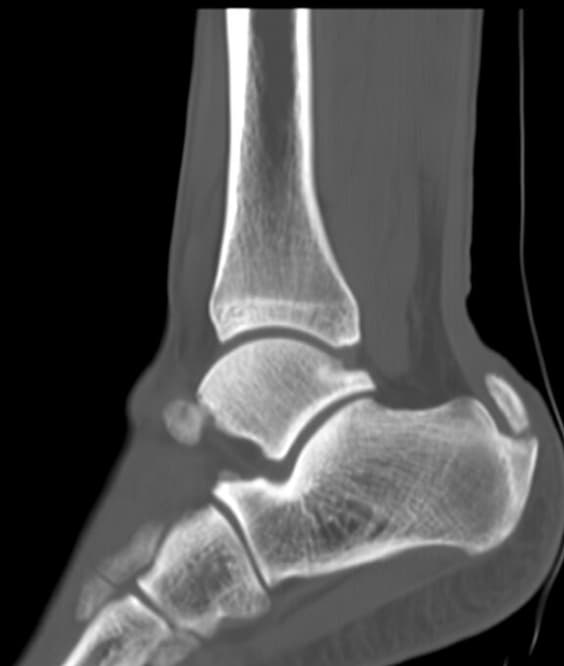 Insertional Achilles on