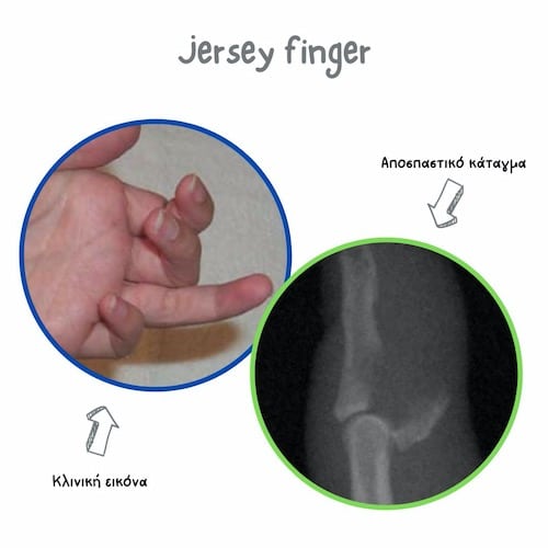 Jersey finger