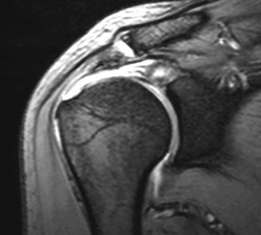 Ρήξη τένοντα ώμου MRI 1