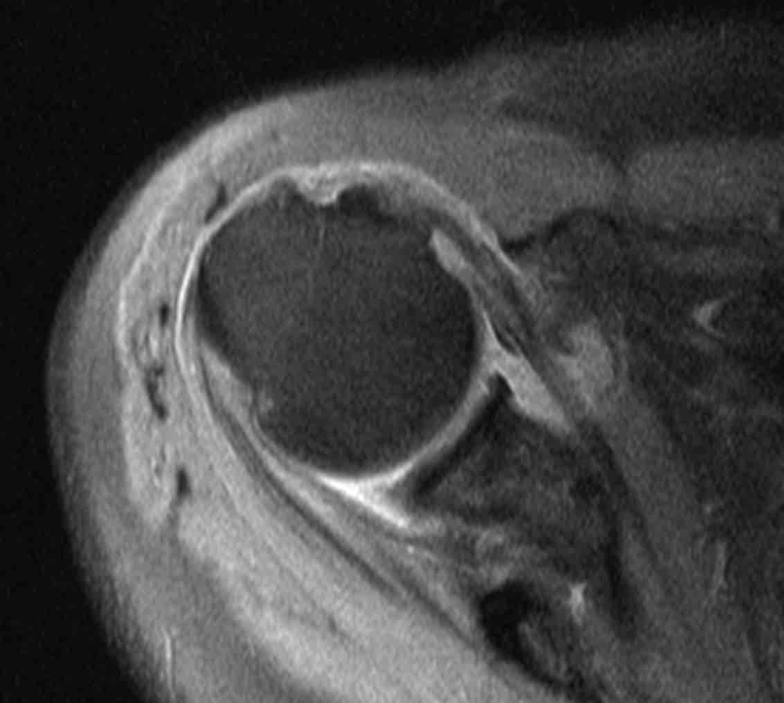 Ρήξη τένοντα ώμου MRI 2