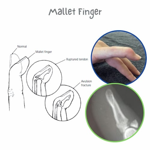 Mallet finger