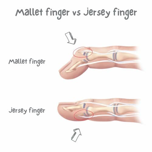 Mallet vs Jersey