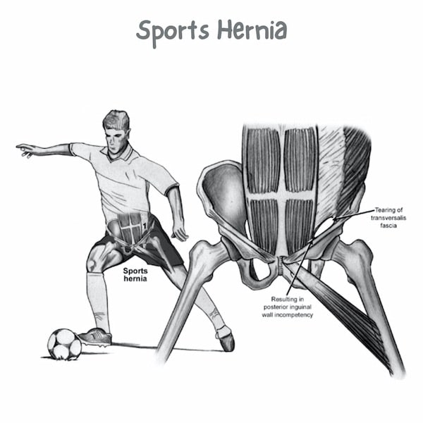 Sports hernia 1