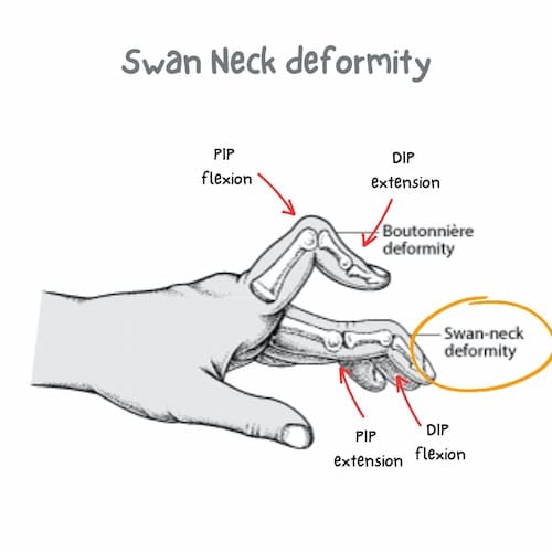 Swan neck deformity