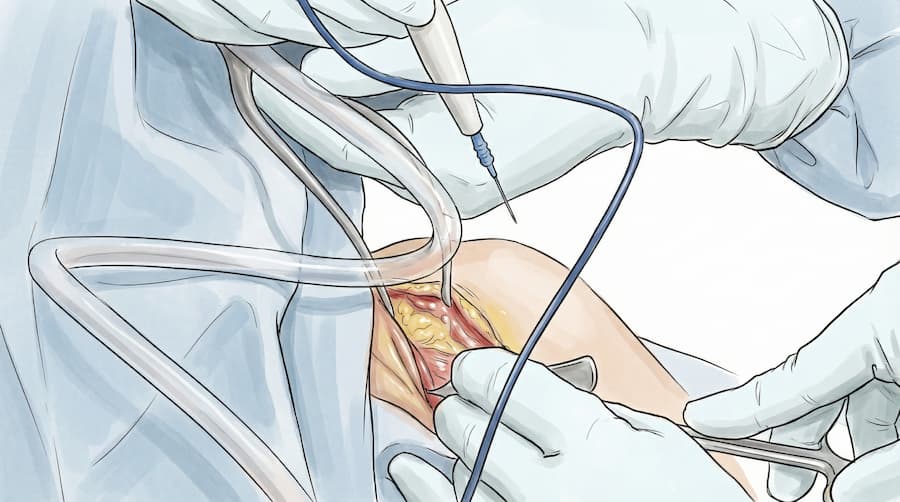 Χειρουργική αποκατάσταση μείζονος θωρακικού 1