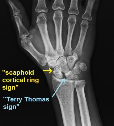 ρήξη σκαφομηνοειδούς συνδέσμου σε ακτινογραφία